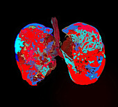 Healthy lungs, CT scan