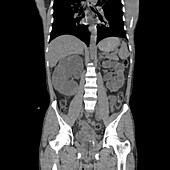 Polycystic kidney disease, CT scan