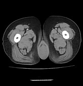 Prolapsed uterus, CT scan