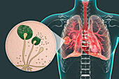 Lung mucormycosis lesion, illustration