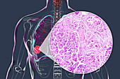 Lung cancer tumour and light micrograph, illustration