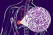 Lung cancer tumour and light micrograph, illustration