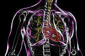 Lung adiaspiromycosis, illustration