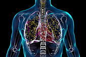 Lungs affected by miliary tuberculosis, illustration