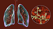 Lung adiaspiromycosis, illustration