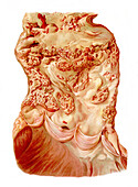 Aortic ulceration, illustration