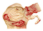 Intestinal ulcer, illustration