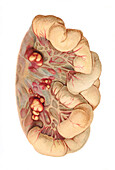 Tuberculosis, illustration