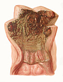 Uterine pathology, illustration