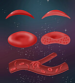 Normal blood cell and sickle cell disease, illustration