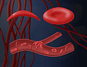 Normal blood cell and sickle cell disease, illustration