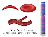 Normal blood cell and sickle cell disease, illustration