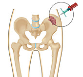 Bone marrow aspiration from the pelvis, illustration