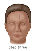 Forehead flap surgery for nose reconstruction, illustration