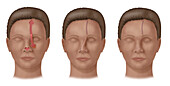 Forehead flap surgery for nose reconstruction, illustration