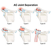 AC joint separation, illustration