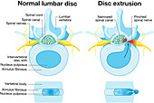 Normal disc and herniated disc, illustration