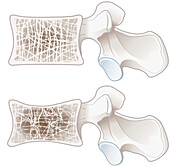 Osteoporosis and normal vertebra, illustration