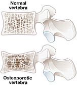 Osteoporosis and normal vertebra, illustration