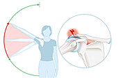 Shoulder impingement, illustration