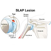 SLAP lesion of the shoulder, illustration