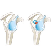 SLAP lesion paralabral cyst in the shoulder, illustration