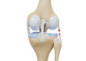 Lateral collateral ligament tear, illustration