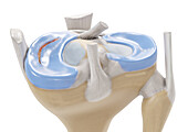 Longitudinal tear meniscus, illustration