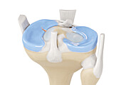 Radial meniscus tear, illustration