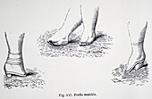 Consequences of foot binding in China, illustration