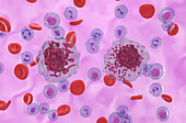 Hypergranular acute promyelocytic leukaemia, illustration