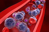 Acute myeloid leukemia, illustration