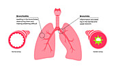Bronchitis and bronchiolitis, illustration