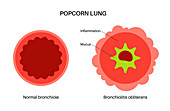 Popcorn lung disease, illustration