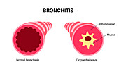 Bronchitis lung disease, illustration