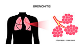 Bronchitis lung disease, illustration