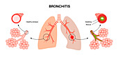 Bronchitis lung disease, illustration