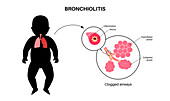 Bronchiolitis lung disease, illustration