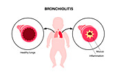 Bronchiolitis lung disease, illustration