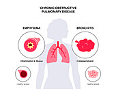 Chronic obstructive pulmonary disease, illustration
