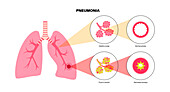 Pneumonia, illustration