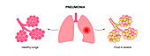 Pneumonia, illustration