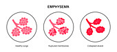 Emphysema, illustration