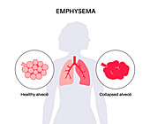 Emphysema, illustration