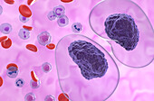 Prolymphocytic leukaemia, illustration