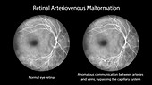 Retinal arteriovenous malformation, illustration