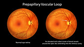 Prepapillary vascular loop on the retina, illustration