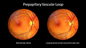 Prepapillary vascular loop on the retina, illustration