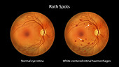 Roth spots in the retina, illustration