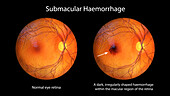 Submacular haemorrhage on the retina, illustration